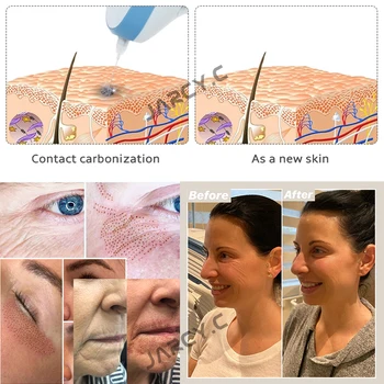 MAGLEV Tattoo Mole Removal Plasma Pen Fibroblast Laser Twarzowy Freckle Dark Spot Remover Usuwanie brodawek Beauty Machine pielęgnacja twarzy