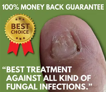 Najlepsze leczenie grzyba paznokci na stopach i paznokciach- gwarancja zwrotu pieniędzy